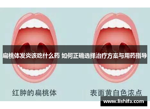 扁桃体发炎该吃什么药 如何正确选择治疗方案与用药指导