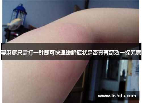 荨麻疹只需打一针即可快速缓解症状是否真有奇效一探究竟